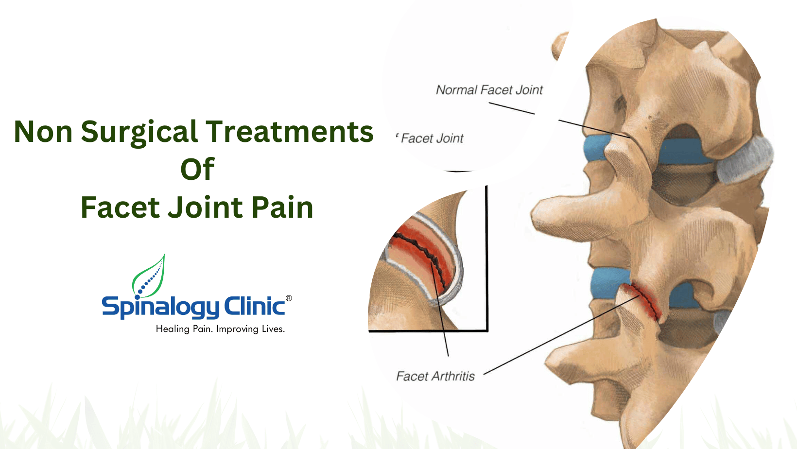 Non Surgical Treatment Of Facet Joint Pain